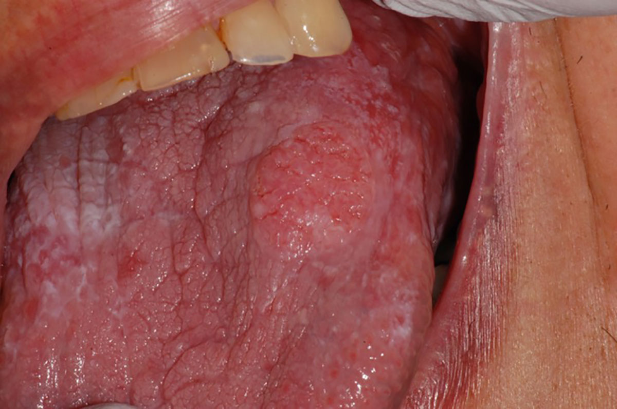 Oral carcinoma