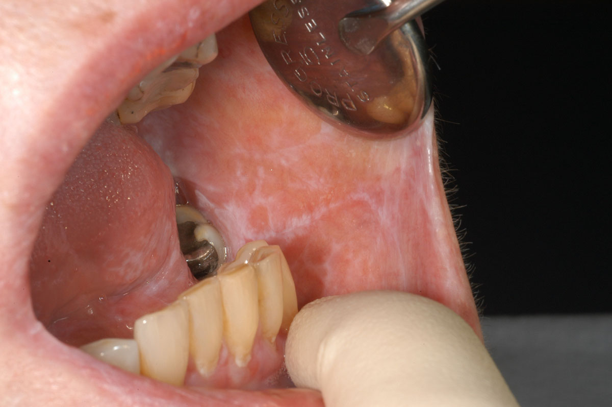 Oral lichen planus