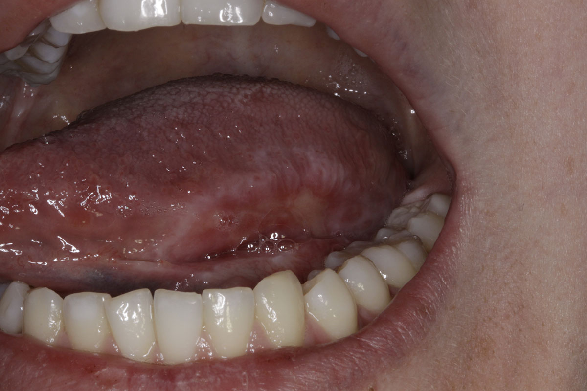 Oral Cancer Lesions On Tongue | Images and Photos finder